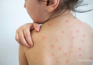 El sarampión es una enfermedad altamente contagiosa y grave, señaló el doctor Padilla, quien insiste en la importancia de prevenir su propagación.